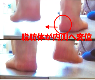 熊本-足底腱膜炎-整体