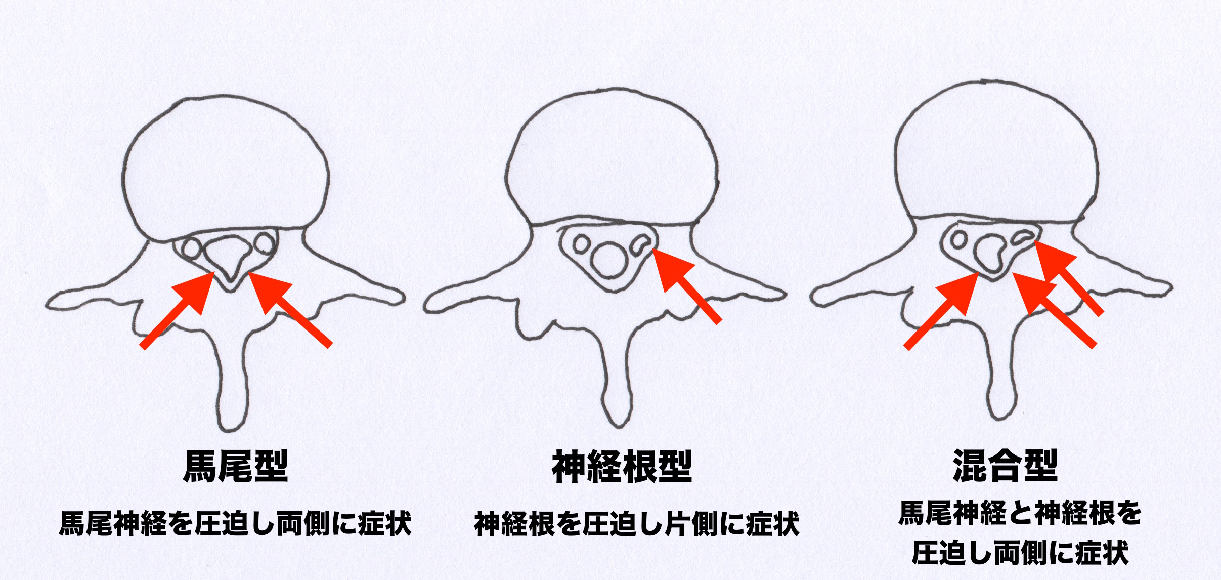 熊本-腰部脊柱管狭窄症-整体
