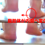 熊本-足底腱膜炎-整体